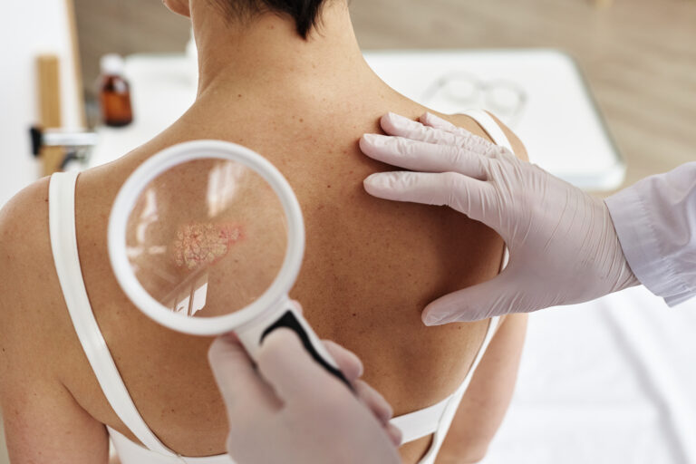Cáncer de piel y sistema inmunológico