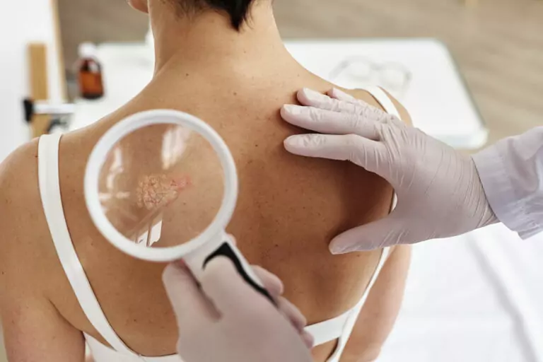 Cáncer de piel y sistema inmunológico