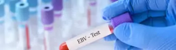 ¿Tiene el virus de Epstein-Barr un papel en la autoinmunidad?