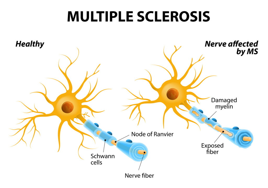 Virus de Epstein-Barr: ¿una posible implicación en la esclerosis múltiple?