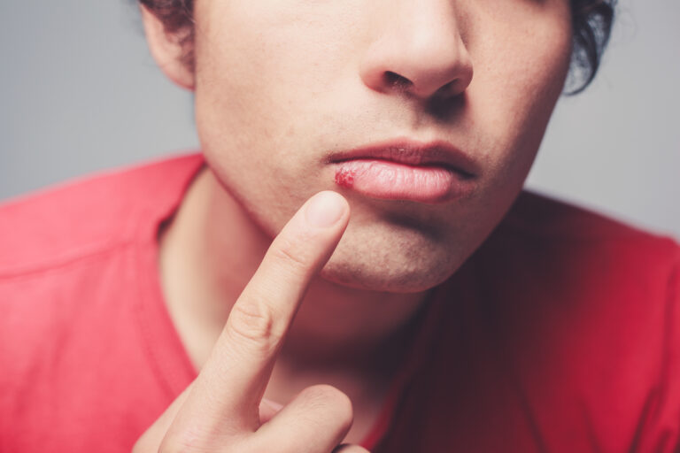 Herpes labial
