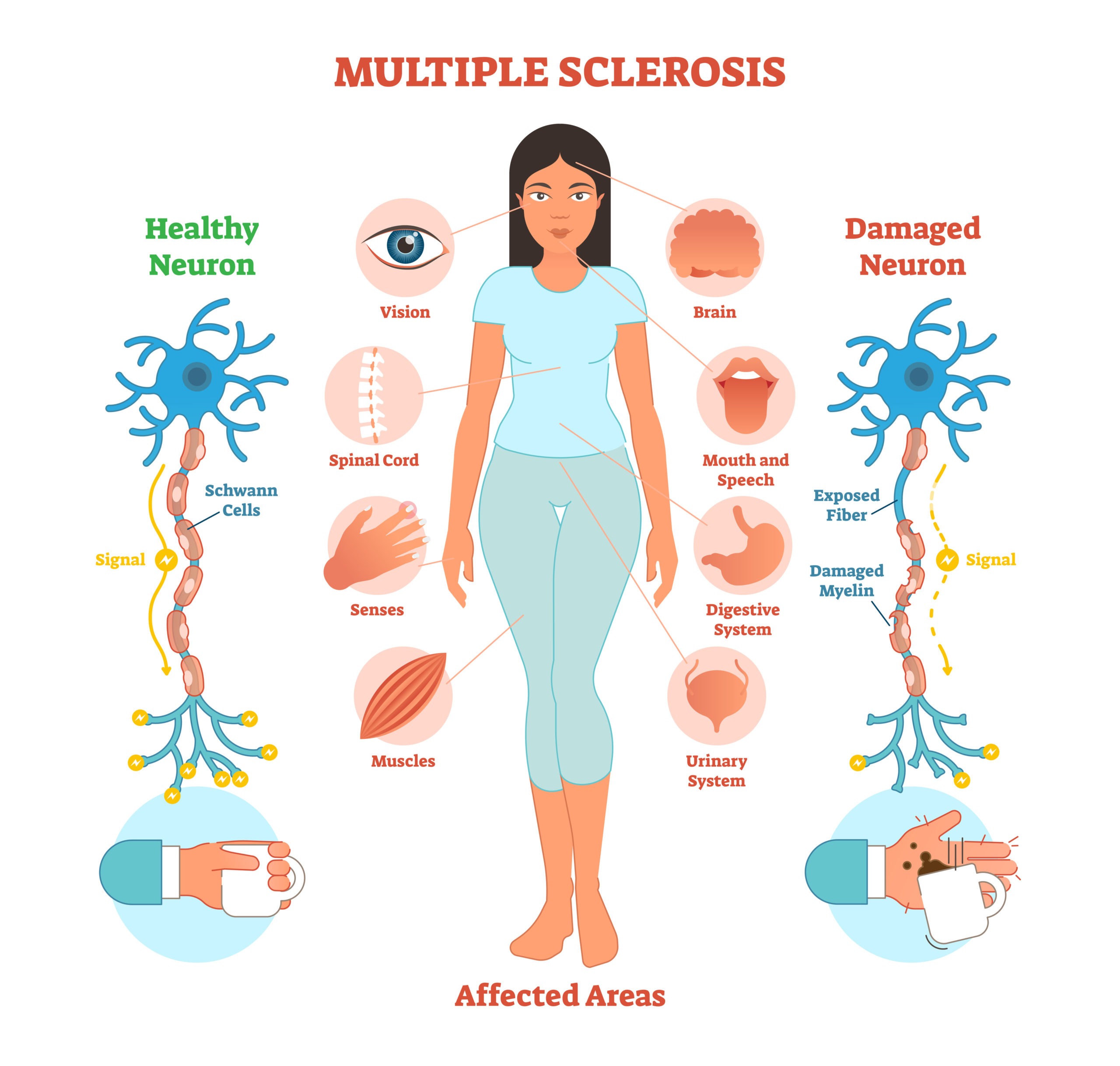 Esclerosis múltiple, una enfermedad del sistema nervioso