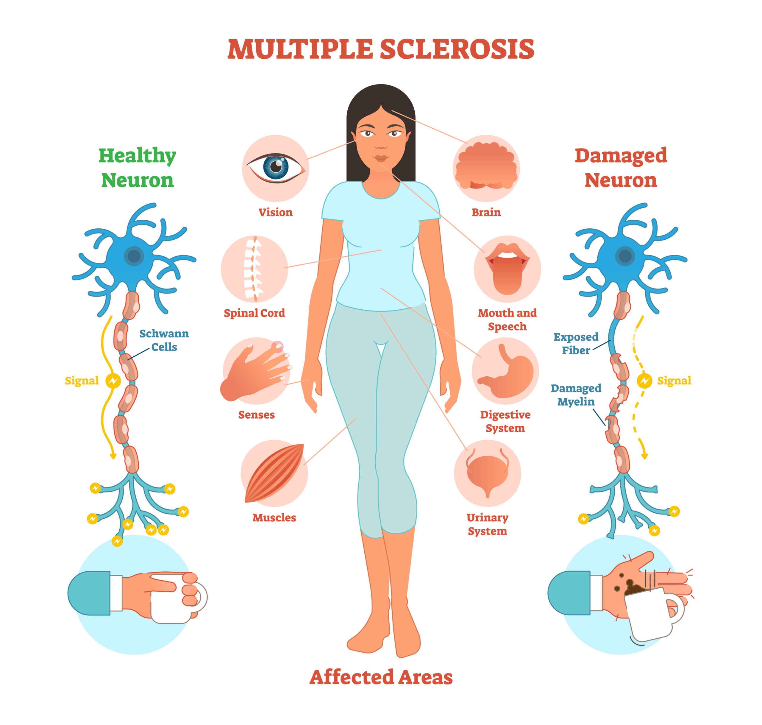 Esclerosis M ltiple Una Enfermedad Del Sistema Nervioso