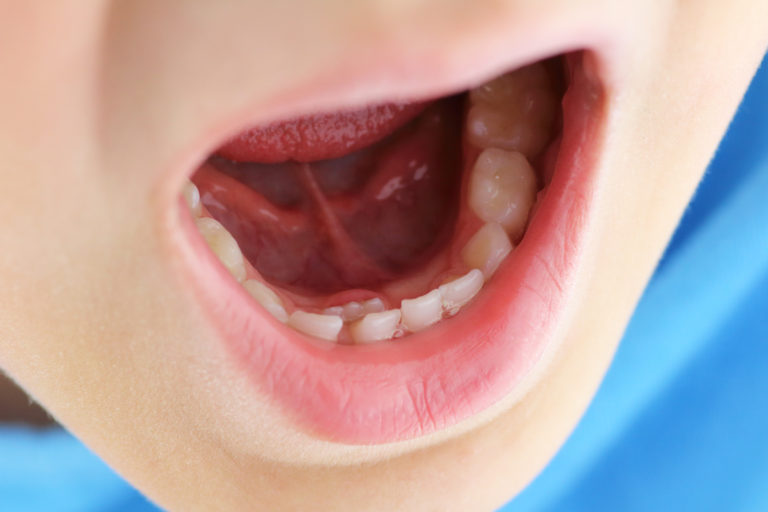 boca de niño con doble fila de dientes