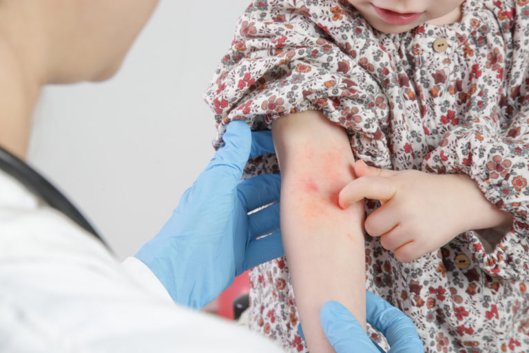 Niña en el médico sufre dermatitis atópica